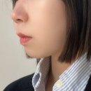 11305-8-300-1 | 세르프리프팅 세르프 300샷 세르프잘하는곳 세르프전후 비교 후기