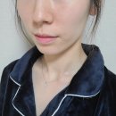 얼굴지방분해주사 , 안면 윤곽주사 후기