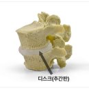 갈산역 정형외과, 디스크절제술로 허리 통증 벗어나기