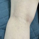 이안메딕스 | 임산부튼살 튼살커버 누아블랑 아카데미후기