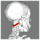 inferior oblique capitis muscle 로 인한 두통 이미지