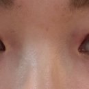 양산 삼성노블의원 쌍수후기