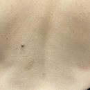 신사-110 | 신사역 등여드름인줄 알았던 편평사마귀 제거 후기