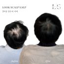 룩스칼프SMP | 목동두피문신 두피가 비어 보인다면? 자연스러운 밀도 강화