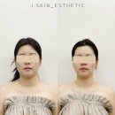 제이메디컬 | 동성로 작은얼굴 관리 잘하는 곳 제이스킨에서 윤곽관리 받은 후기