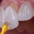 비우고채우는치과의원 | 왜소치 치료, 어디까지 자연스러워봤니?] 광주 광산구 자연치 살리기 치과