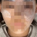대본약국 | [주근깨 레이저] 압구정 루비레이저 / 시술 전 읽어보길 추천하는 내돈내산 솔직 후기(1)