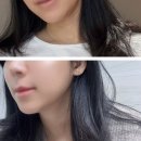 에이포의원 | 강남 압구정 이중턱레이저 온다리프팅 에이포의원 후기