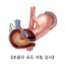 췌장암 (Pancreatic cancer )의 원인과 치료 이미지