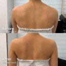 아로벨 | [안산] 웨딩관리 아로벨뷰티에서 드레스라인 케어받은 후기