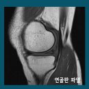 무릎통증과 무릎연골판파열 방법은 관절내시경수술!! 이미지