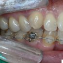 용두치과의원 | 회기역 대학병원급 완전매복 사랑니 당일 발치 후기, 신경손상 감각이상 가능성 최소화 하려면, 믿음...