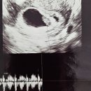 미즈정문온누리약국 | 대전 미즈제일병원 임신 11주차 기형아검사 후기 | 검사비용·독감접종·산전검사 꿀팁까지