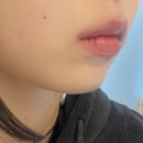 강남역성형외과 턱필러후기 | 신논현역 쥬비덤 턱끝필러 내돈내산 리얼후기😻