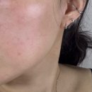 바이오컴 | 음식물 과민증 검사 후기 바이오컴 하는 방법 및 해야 되는 이유