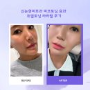 라라약국 | 신논현피부과 피코토닝 효과 듀얼토닝 라라필 후기