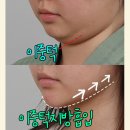 치유성형외과의원 | 이중턱지방흡입후기💎치유성형외과에서 투턱 고민 해결!