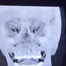 빅매치복싱 | 제이크 폴, 턱뼈 골절 후 7일간 액체 식사…조슈아전 참패 비하인드