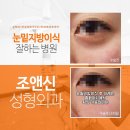 눈밑지방이식후기 다크써클없애는법 / 다크서클없애는법, 눈밑꺼짐 다크서클없애는방법을 알려드립니다 이미지