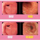 한포진 드디어 완치!! 손가락 수포 지긋했는데 면역력 회복 후기