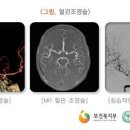 뇌출혈진단(체증형)보장 이미지