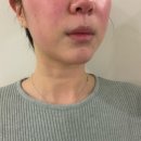 더디씨 신곡점 | 의정부피부관리 성형안해도청초 신곡점 얼굴윤곽관리 솔직후기