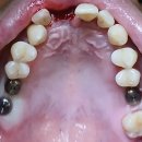 🦷 상악동 거상술 + 무절개 임플란트 4개, 하루 만에 끝낸 수술 후기