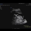 맘줌님덜 초음파 각도법 봐주세요..😊 이미지