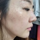 신흥역- 원탑성형외과 리쥬란힐러 강추후기