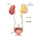 요관 협착[Ureteral stricture] 이미지