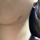 푸름약국 | 얼굴 돌출점/큰점 제거 후기 | 한달 후기 총정리