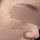 지성한방병원 | 전주 내돈내산 주근깨제거 솔직후기, 피코토닝 솔직후기