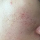 해나한의원 | 여드름흉터 | 부산 새살침 한의원 | 코&amp;볼 깊은 패인 흉터치료 | 내돈내산 | 3회차후기