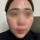 베리윤뷰티 | 광주피부관리 잘하는곳 첨단 베리윤뷰티 플라즈마 후기