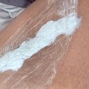 나세르의원 | 강남 나세르의원 타투 제거 후기, 1주~2주차 통증 및 경과 완벽 정리