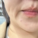 400 | 강남 리프팅으로 받은 울타이트 400샷 후기 리프팅 추천!!