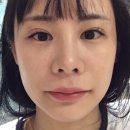 색소레이저 피코토닝 패키지 4회차, 5회차, 6회차 솔직후기~