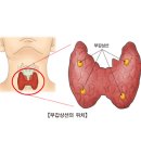 부갑상선암 Parathyroid Cancer 유방내분비질환, 종양혈액질환 이미지