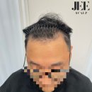 지스칼프