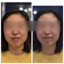 수유역두피관리 얼굴라인이 달라지는 벨리시모 스칼프핏