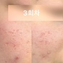 희빛 | 대구 모공관리 모공 슛 맛집 리얼 후기 + 촉촉한 황치즈칩 맛집