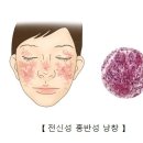 전신 홍반성 낭창(루푸스) 낭창[狼瘡] 이미지