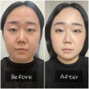 인터넷유니버스 | 부산 경성대 근처 피부과 슈링크유니버스 윤곽주사 이중턱 관리 내돈내산 후기