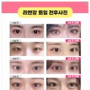 더예쁜성형외과의원 네이버블로그