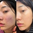 멍뽀인트 | 대구 범어동 피부과 리투오 콜라겐 스킨부스터 후기