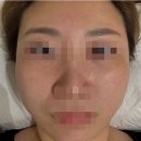 오르다한의원 | 이마 흉터치료 패인흉터 수술흉터제거 새살침 내돈내산 후기