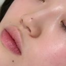 미인 | 양산미인점 증산 와이엘라 미인점시술 후기