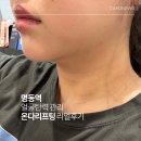 명동신발 - 순천시 황금1길 1-1 | 심부볼 두턱때문에 받은 명동 온다리프팅, 리얼 후기