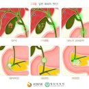 담관염cholangitis 이미지