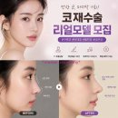 코재수술 성형 리얼모델 모집! 실패 코, 마지막 기회!마스터컴퍼니에서!
